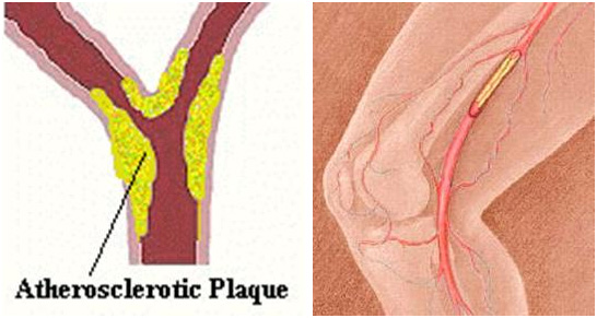 Shematski prikaz najčešćeg rasporeda aterosklerotskog plaka na račvama arterija