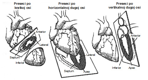 Shematski prikaz rekonstrukcije preseka po anatomskoj osi srčanog mišića